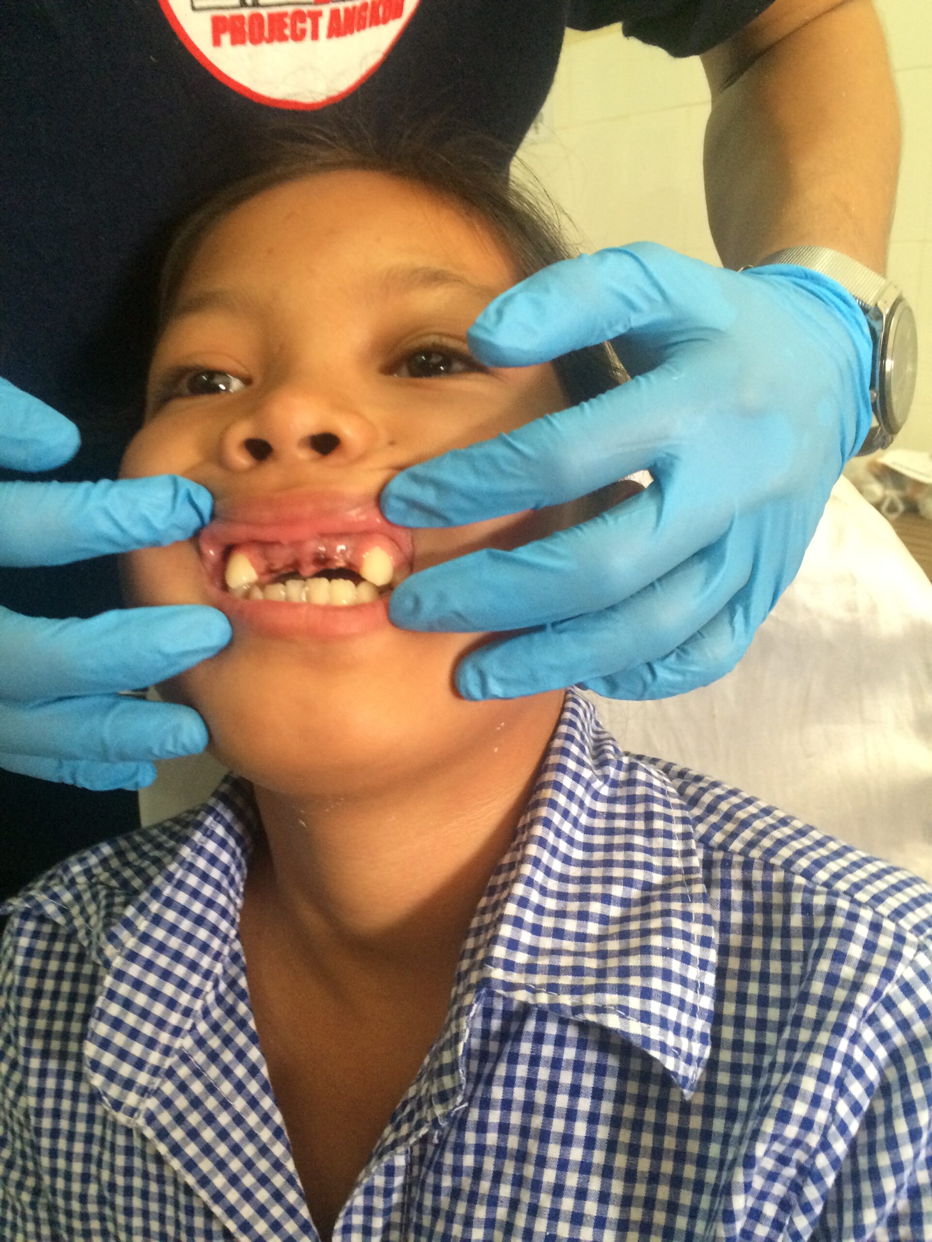 A young girl in a blue checked school shirt opens her mouth for a volunteer, showing her missing front teeth